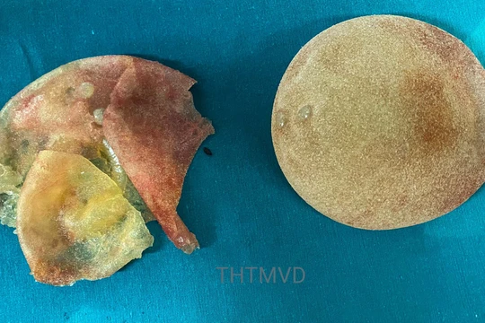 Túi ngực vỡ của chị V. được lấy ra sau 5 năm phẫu thuật nâng ngực (Ảnh - Bệnh viện Hữu nghị Việt Đức) 