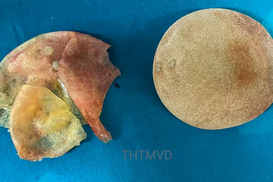 Túi ngực vỡ của chị V. được lấy ra sau 5 năm phẫu thuật nâng ngực (Ảnh - Bệnh viện Hữu nghị Việt Đức) 