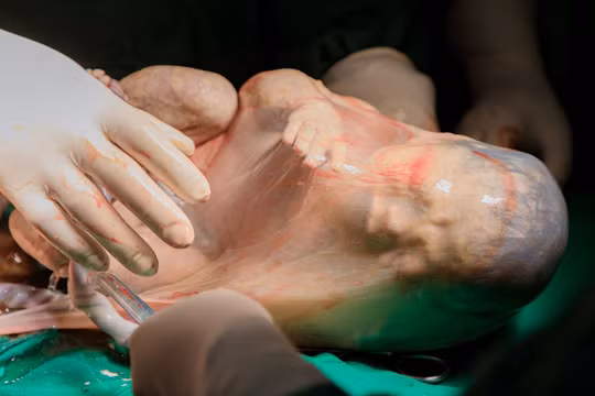 Bé trai thứ 2 của chị M. chào đời vẫn nằm nguyên trong bọc ối (Ảnh - BVCC) 