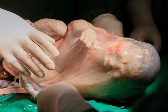 Bé trai thứ 2 của chị M. chào đời vẫn nằm nguyên trong bọc ối (Ảnh - BVCC) 