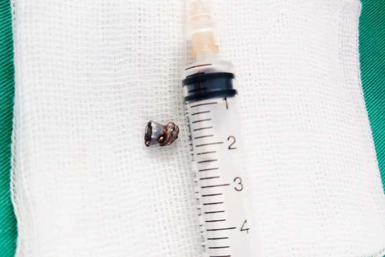 Viên đạn bắn xuyên cổ nam thanh niên 29 tuổi (Ảnh: BVCC) 