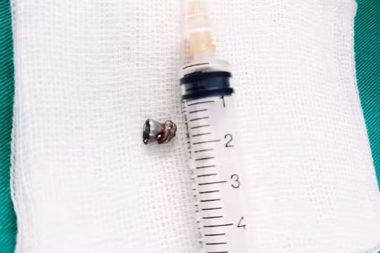 Viên đạn bắn xuyên cổ nam thanh niên 29 tuổi (Ảnh: BVCC) 