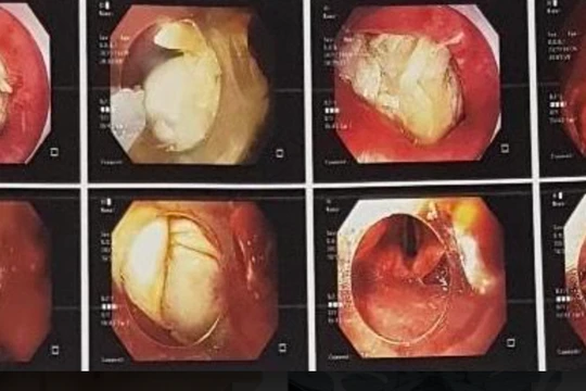 Hình ảnh xương gà mắc trong cổ họng bệnh nhân (Ảnh - BVCC) 