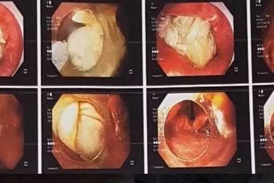 Hình ảnh xương gà mắc trong cổ họng bệnh nhân (Ảnh - BVCC) 