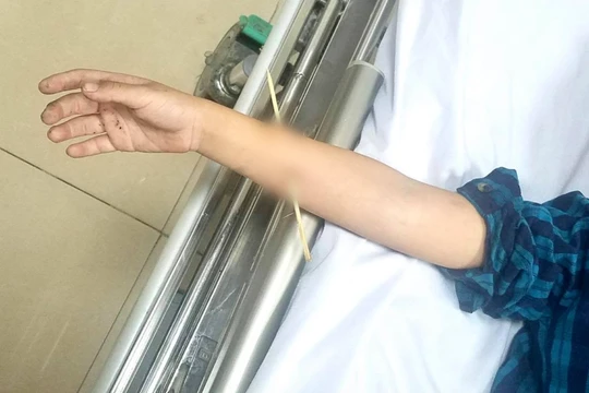 Bé trai 6 tuổi không may bị xiên tre đâm xuyên cẳng tay phải (Ảnh: BVCC)