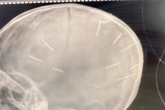 Hình ảnh chụp X-Quang hộp sọ bệnh nhân với 9 hình thể nghi là đinh (Ảnh: Bệnh viện Đa khoa huyện Thạch Thất cung cấp)