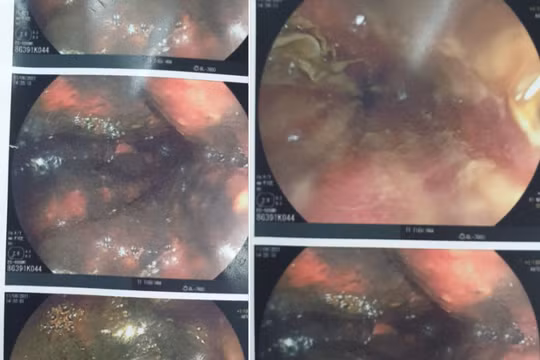 Hình ảnh nội soi đường tiêu hóa của bệnh nhân bị viêm loét phù nề, xung huyết mạnh (Ảnh - BVCC) 