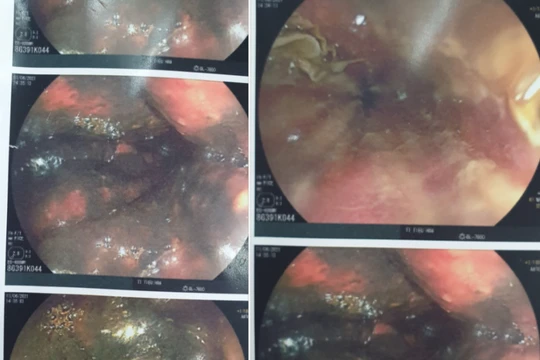 Hình ảnh nội soi đường tiêu hóa của bệnh nhân bị viêm loét phù nề, xung huyết mạnh (Ảnh - BVCC) 