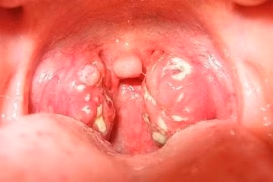 Hình ảnh trẻ bị viêm amidan quá phát (Ảnh - BVCC)