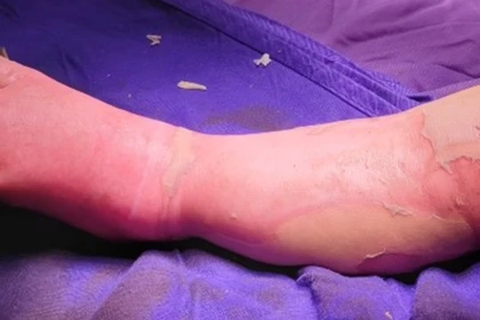 Khi trẻ bị bỏng, các bậc phụ huynh không nên tự ý điều trị cho con bằng các loại thuốc lá, các loại cây không rõ nguồn gốc (Ảnh minh họa) 