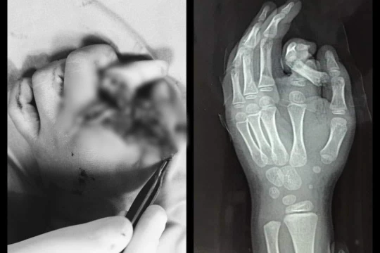 Ngón tay bé trai bị đứt rời vì cho tay vào máy giặt (Ảnh: BVCC)