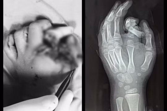 Ngón tay bé trai bị đứt rời vì cho tay vào máy giặt (Ảnh: BVCC)