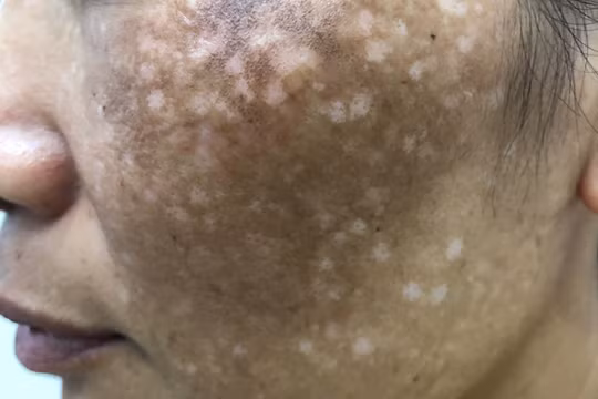 Chị T. bị sẹo trắng loang lổ khắp má sau khi trị rám má tại ở một số cơ sở thẩm mỹ trước khi đến Bệnh viện Da liễu Trung ương để điều trị (Ảnh: BVCC) 