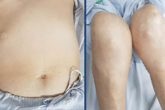 Bệnh nhân bị teo cơ tứ chi, béo bụng, rạn da vùng bụng, da mỏng, dễ xuất huyết vì lạm dụng corticoid để trị đái tháo đường. (Ảnh: BVCC) 