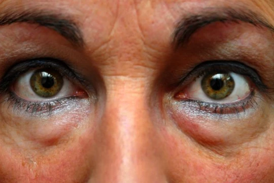 Mắt "gấu trúc" khiến sắc đẹp của chị em bị xuống cấp (Ảnh: Brightside) 