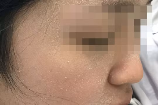 Một bệnh nhân da bị bong tróc trong mùa hanh khô (Ảnh: Bệnh viện Da liễu Trung ương)