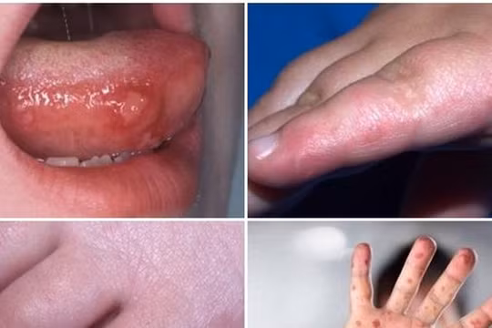 Bệnh tay chân miệng ở trẻ (Ảnh: BV Nhi TW) 