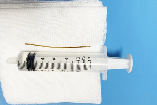 Chiếc tăm được lấy ra từ bụng bệnh nhân. (Ảnh: Bệnh viện Đại học Y Hà Nội)