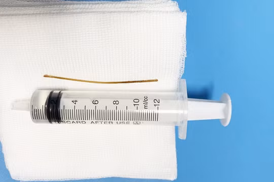 Chiếc tăm được lấy ra từ bụng bệnh nhân. (Ảnh: Bệnh viện Đại học Y Hà Nội)