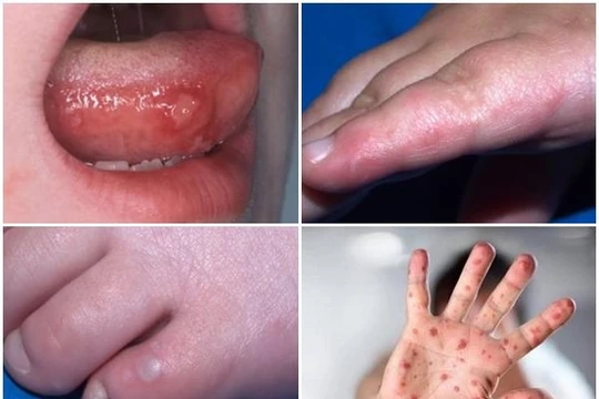 Hình ảnh trẻ mắc tay chân miệng (Ảnh: Bệnh viện Nhi Trung ương) 