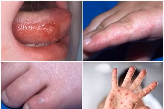 Hình ảnh trẻ mắc tay chân miệng (Ảnh: Bệnh viện Nhi Trung ương) 