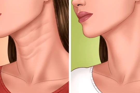Nếu không hành động sớm, những nếp nhăn ở cổ sẽ tấn công bạn (Ảnh: Brightside) 
