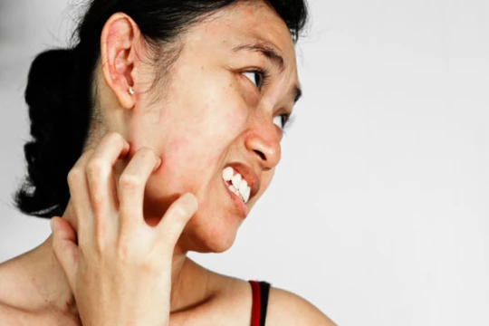 Tẩy da chết không đúng cách có thể khiến da bị tổn thương (Ảnh: Boldsky) 