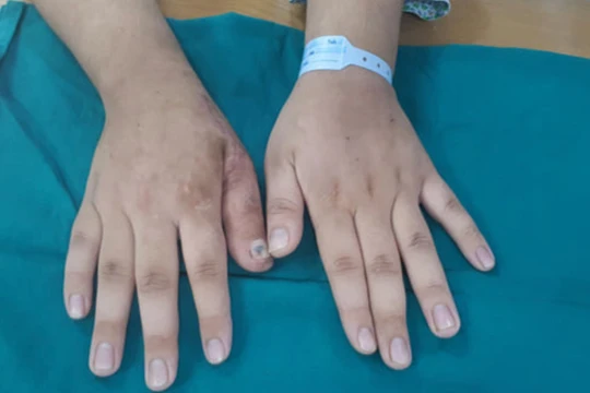 Bàn tay của bệnh nhân sau phẫu thuật (Ảnh: BVCC) 