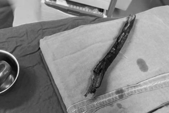 Cây gỗ đâm xuyên vùng mặt của bệnh nhân (Ảnh: BVCC) 