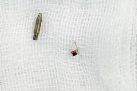 Cây bút bi khiến bé trai 12 tuổi bị chấn thương vùng bìu (Ảnh - BVCC) 