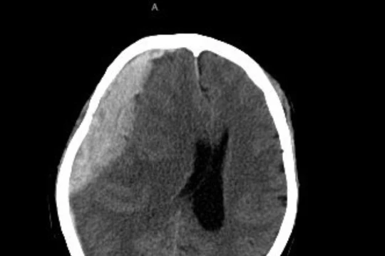 Khối máu tụ lớn trong não của cụ N. (Ảnh - BVCC) 