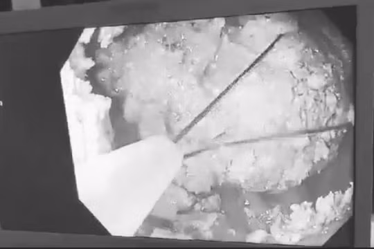 Bác sĩ nội soi dạ dày để loại bỏ khối bã thức ăn từ 5 quả hồng ngâm cho bệnh nhân (Ảnh: BVCC) 