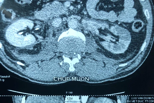 Phim chụp trước mổ của bệnh nhân D. (Ảnh: Bệnh viện Hữu nghị Việt Đức) 