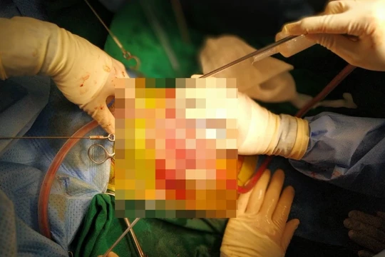 Các bác sĩ phẫu thuật ổ bụng cho bé gái bị thủng bụng, lộ toàn bộ ruột non (Ảnh - BVCC) 