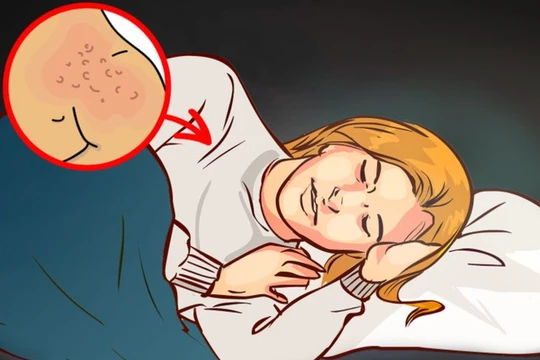 Da nổi mụn vì mặc quá ấm khi đi ngủ (Ảnh: Brightside) 