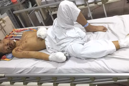 Thiếu niên 15 tuổi chấn thương nặng vì pháo tự chế phát nổ (Ảnh: BVCC) 