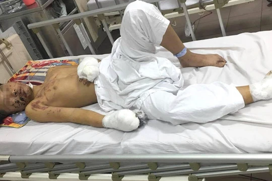 Thiếu niên 15 tuổi chấn thương nặng vì pháo tự chế phát nổ (Ảnh: BVCC) 