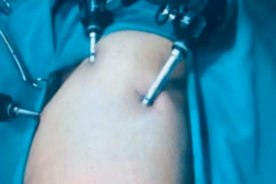 Các bác sĩ phẫu thuật nội soi cho bệnh nhi (Ảnh - BVCC)