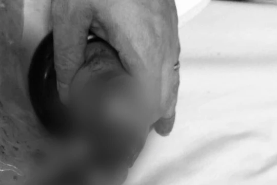 Bàn tay trái của bé gái bị dập nát vì cho vào máy xay hoa quả (Ảnh - BVCC) 