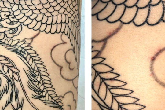 Nam thanh niên bị nhiễm trùng da sau xăm hình (Ảnh: BVCC) 