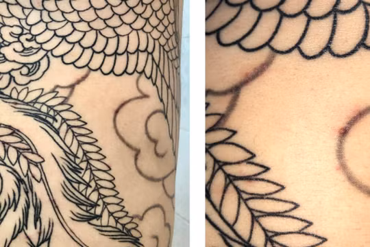 Nam thanh niên bị nhiễm trùng da sau xăm hình (Ảnh: BVCC) 