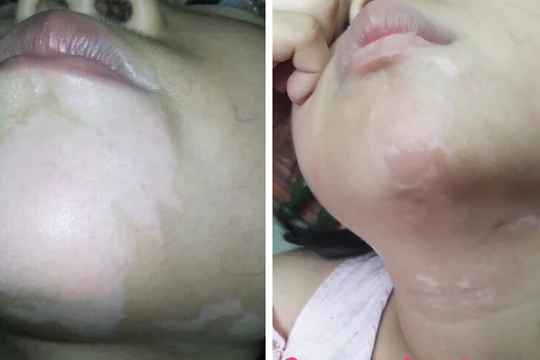 Bệnh nhân bị bệnh bạch biến sau 2 tháng làm phương pháp ghép tế bào thượng bì tự thân. Ảnh: Bệnh viện Da liễu Trung ương. 