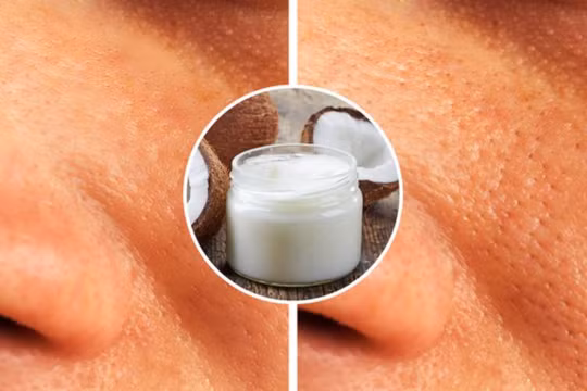Bôi dầu dừa thay vì kem dưỡng ẩm có thể gây bít lỗ chân lông (Ảnh: BrightSide)
