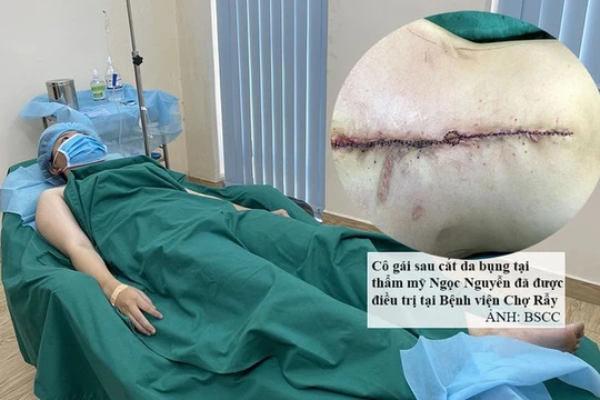 Bệnh nhân bị biến chứng nặng nề sau hút mỡ bụng (Ảnh: BSCC) 