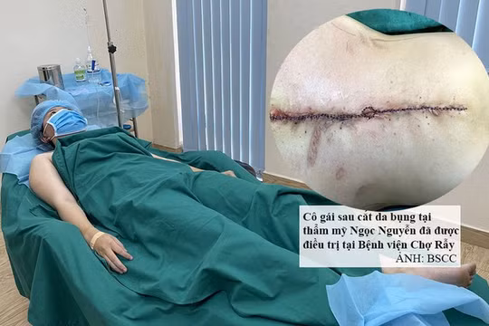 Bệnh nhân bị biến chứng nặng nề sau hút mỡ bụng (Ảnh: BSCC) 