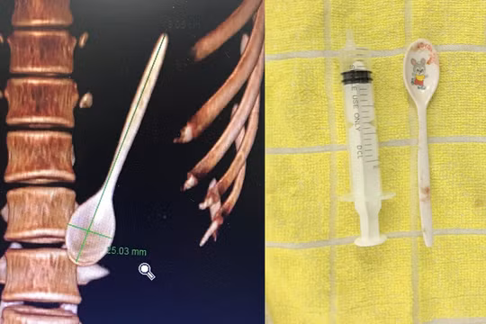 Hình ảnh thìa nhựa bên trong đường tiêu hoá của bệnh nhân từ phim chụp và sau khi lấy ra ngoài