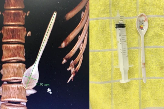 Hình ảnh thìa nhựa bên trong đường tiêu hoá của bệnh nhân từ phim chụp và sau khi lấy ra ngoài