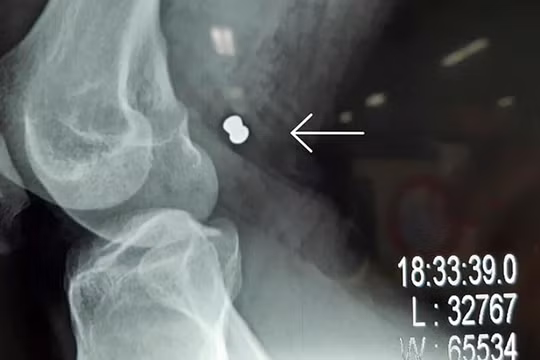 Phim X-ray chụp viên đạn ghim vào đùi gây vở động mạch và tĩnh mạch đùi của bạn nhân