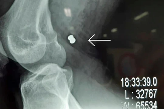 Phim X-ray chụp viên đạn ghim vào đùi gây vở động mạch và tĩnh mạch đùi của bạn nhân