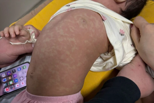 Nhiều trẻ mắc bệnh sởi những ngày đầu năm